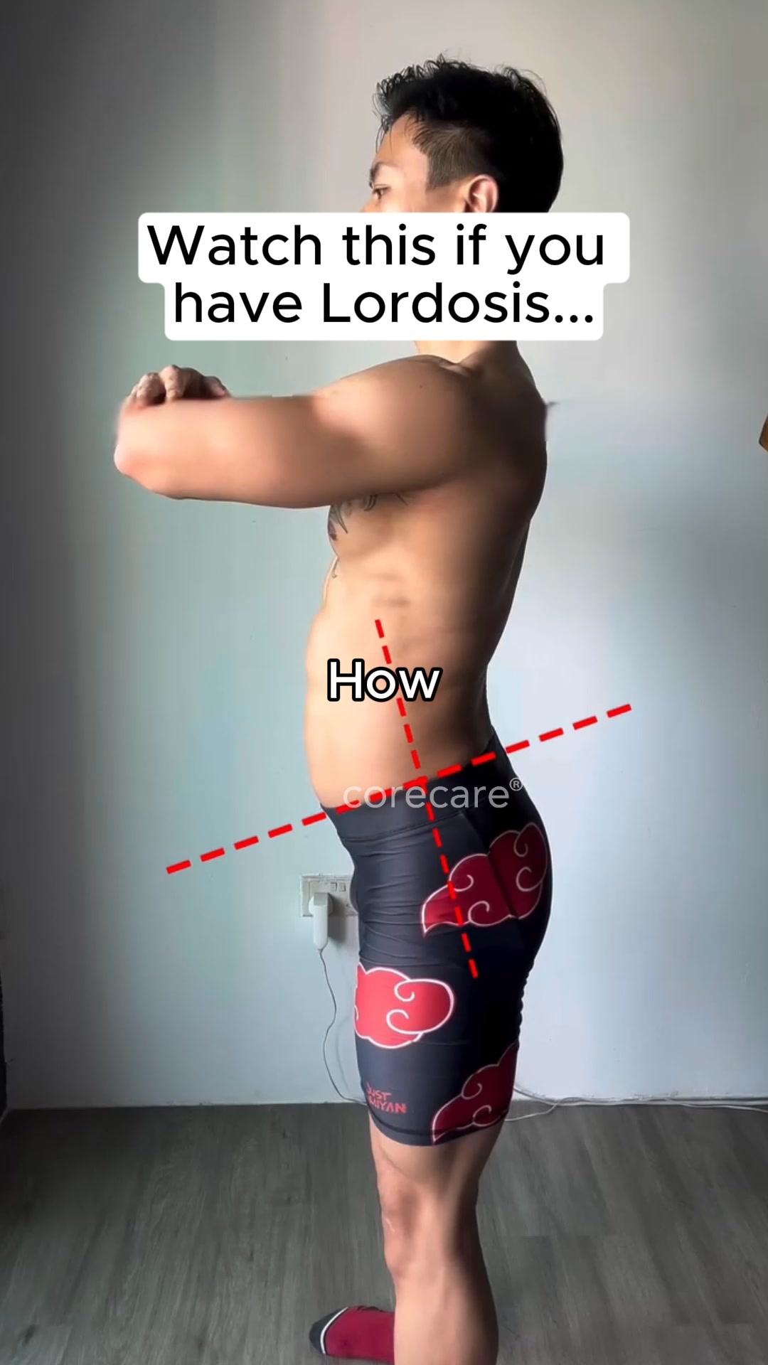 How To Fix Anterior Pelvic Tilt (FOREVER)